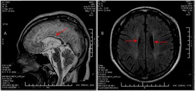 Case report: Novel mutations in the SPG11 gene in a case of autosomal recessive hereditary spastic paraplegia with a thin corpus callosum